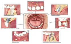 Laser Dentistry