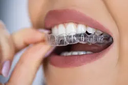 Teeth Aligner