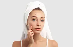 Acne Treatment