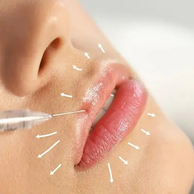 Lip Filler Injections: Top Questions to Ask Your Injector