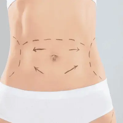 Simple Pre-Surgery Checklist for Your Tummy Tuck