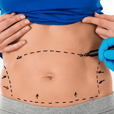 Can a Tummy Tuck Fix a Muffin Top?