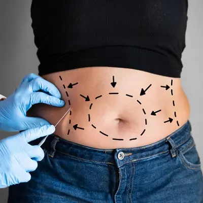 What is Liposuction and How Does It Work?