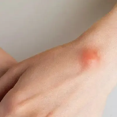 Lipoma Treatment Recovery: What to Expect After Removal