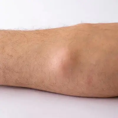 Lipoma Treatment Techniques That Minimize Downtime