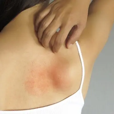 Lipoma Treatment: Causes, Symptoms, and Options Explained
