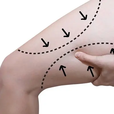 How a Thigh Lift Can Transform Loose, Sagging Skin