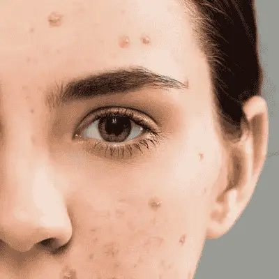 Laser vs Acne Scar Treatment: Which Gives Better Results?