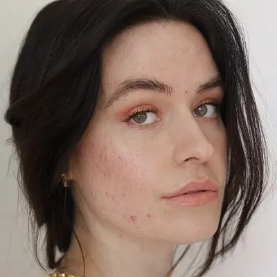 Is Acne Treatment Permanent or Temporary Solution?