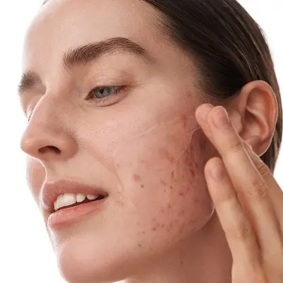 Fastest Working Acne Treatment Methods Explained