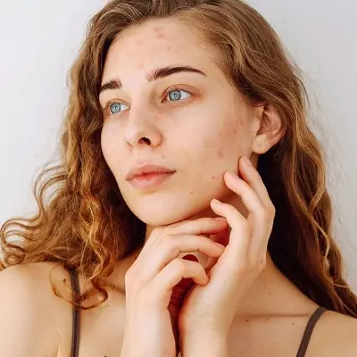 Best Tips Before Starting an Acne Treatment Plan