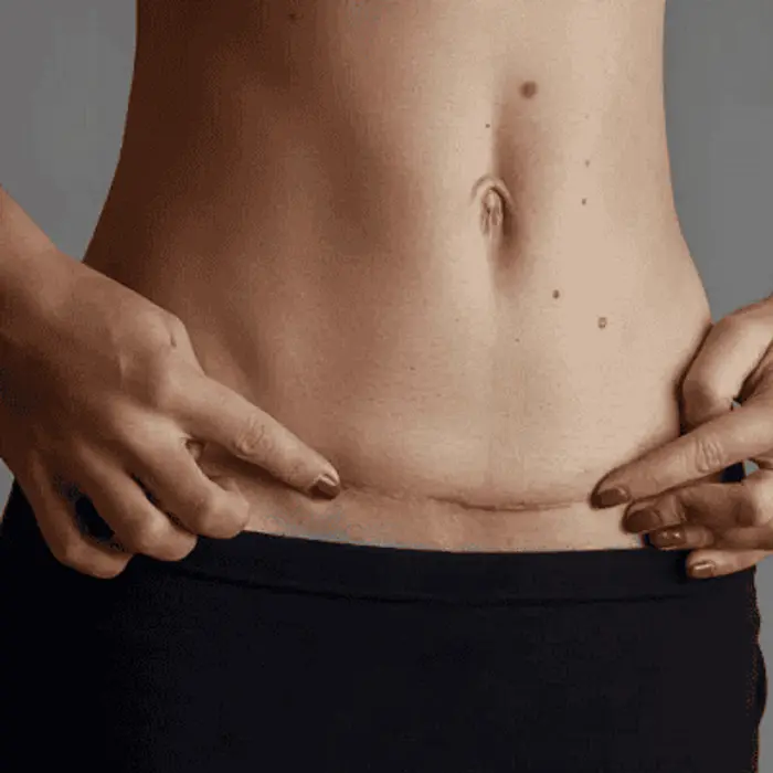 Tummy Tuck Recovery Timeline: What to Expect Week by Week