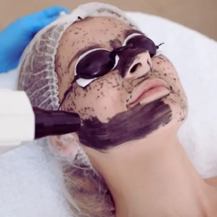 Laser Carbon Peel vs Chemical Peel: Key Differences