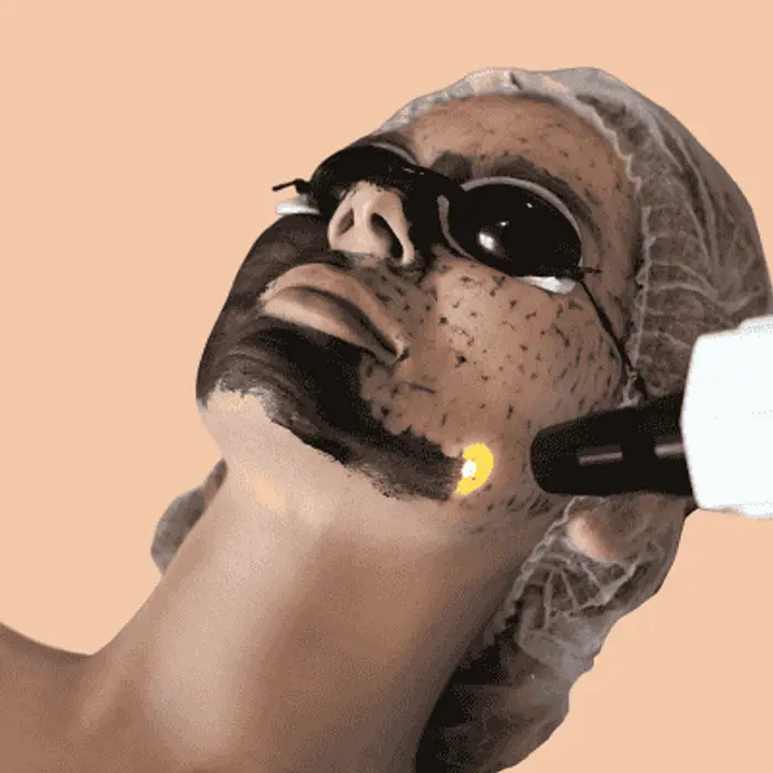 Your Complete Laser Carbon Peel Buying and Care Guide