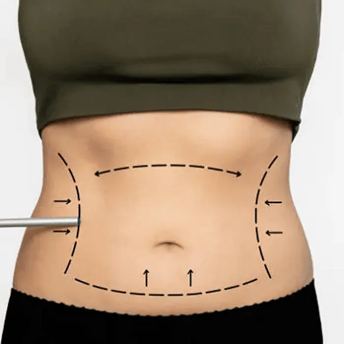 How Long Do Laser Liposuction Results Last?
