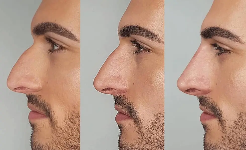 Hiko Nose Thread Lift for Patients Avoiding Surgery