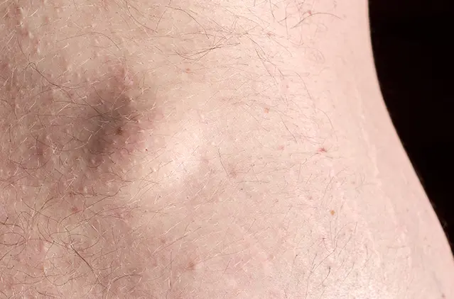 Lipoma Treatment and Skin Appearance Improvement