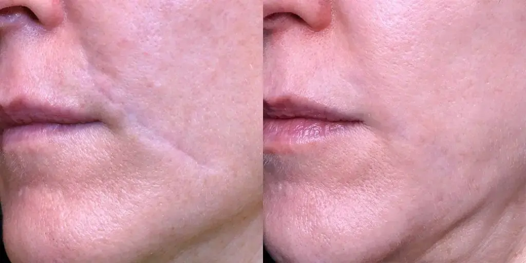 Does Surgical Scar Revision Work for All Skin Types?
