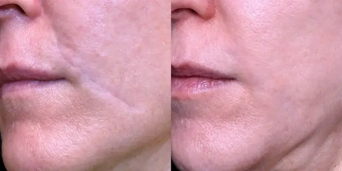 Does Surgical Scar Revision Work for All Skin Types?