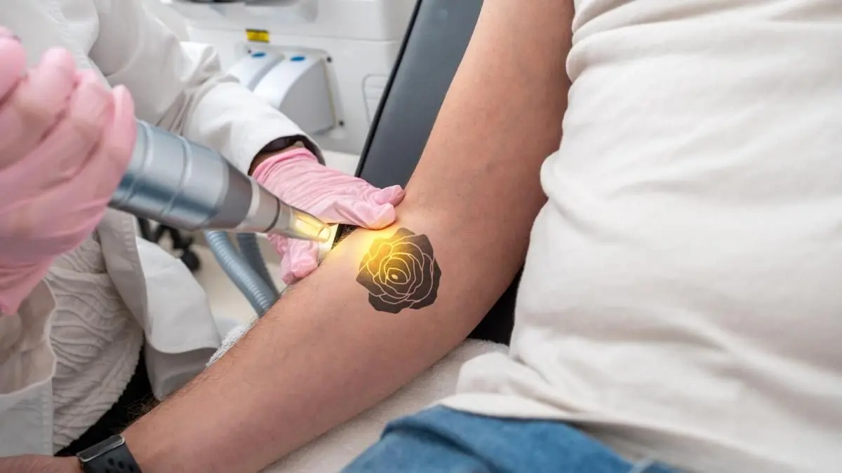 Can Picosure Laser Tattoo Removal Unlock Fresh Skin Without Any Marks