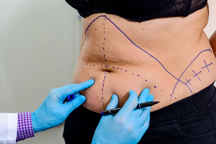 Liposuction in Dubai Featuring Innovative Solutions