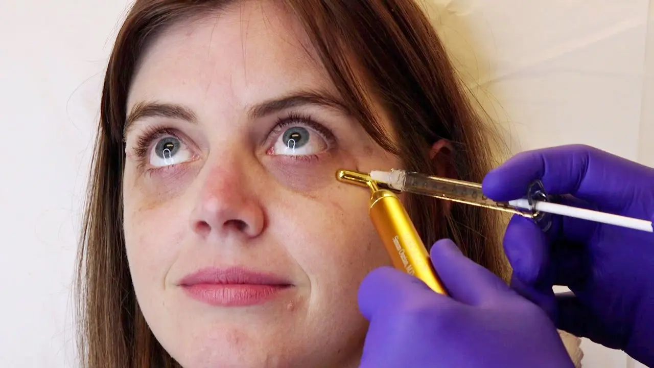 Can Under-Eye Filler Treatment Reduce Eye Hollows?