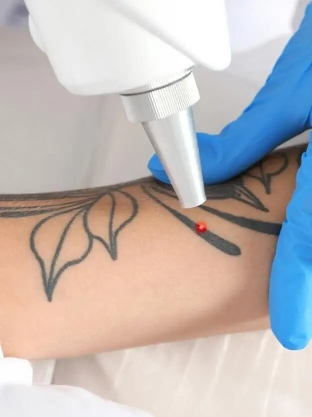 How Does Laser Tattoo Removal Support Tattoo Removal Goals?