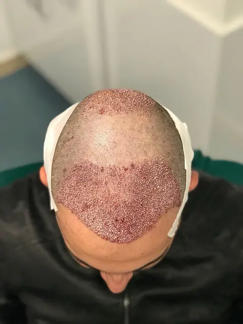 How Does Hair Transplant Restore Hair in Bald Areas?