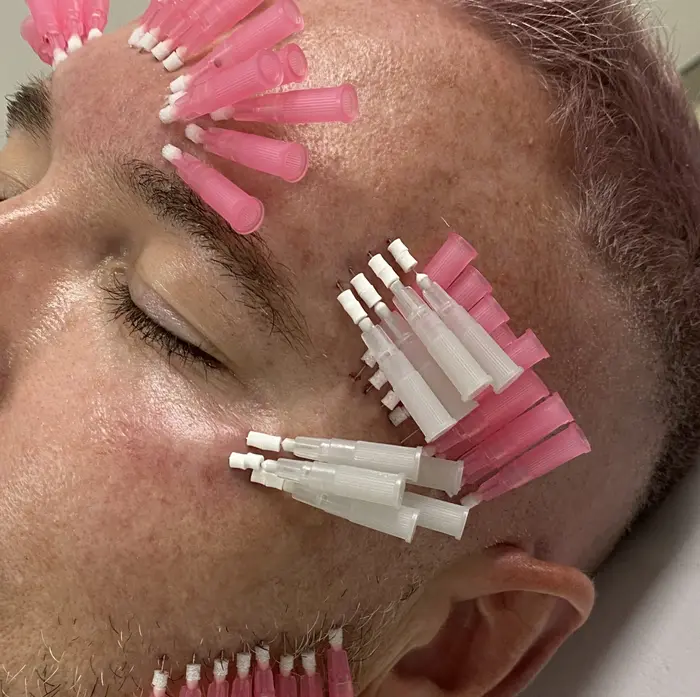 How Do PDO Mono Threads Improve Skin Tightening?
