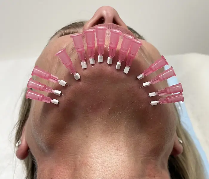 What Skin Problems Can PDO Mono Threads Actually Treat?