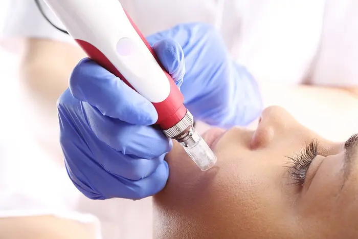 How Long Does It Take to See Microneedling Results?