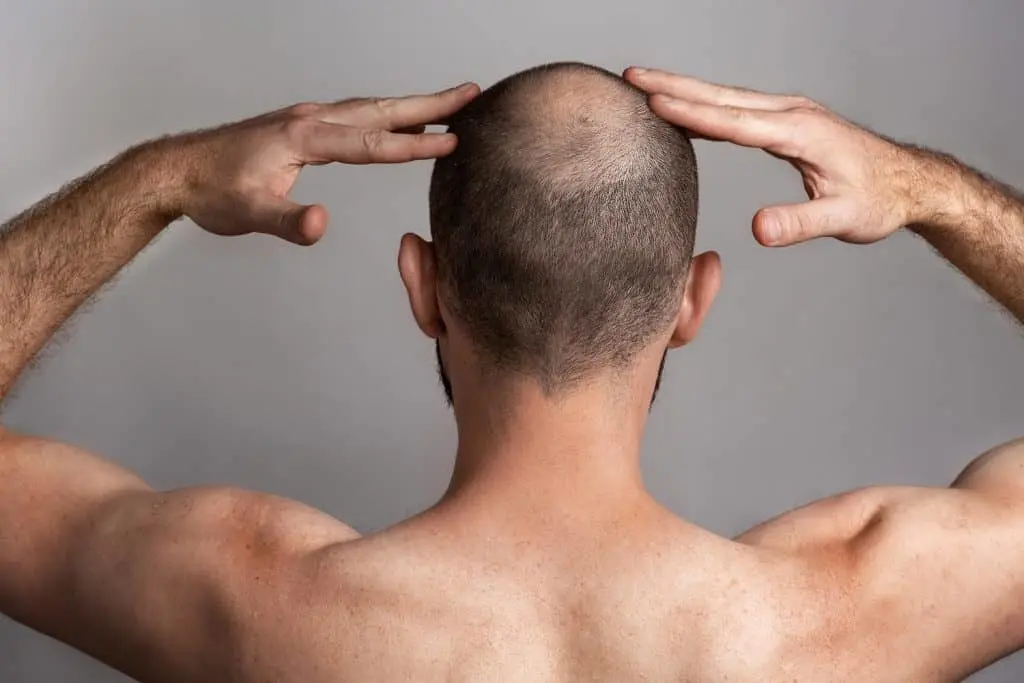 Can crown hair transplant improve overall scalp coverage?