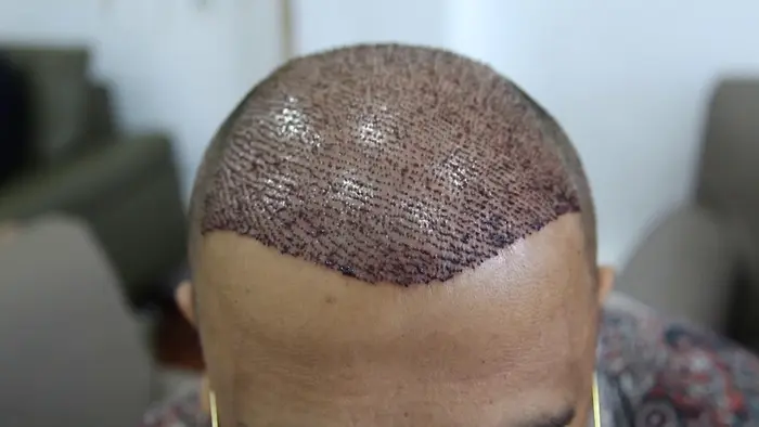 How Does Hair Transplant Improve Hair Density?