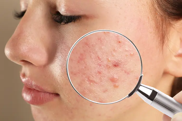 What Causes Pimples and How Can Treat Them?