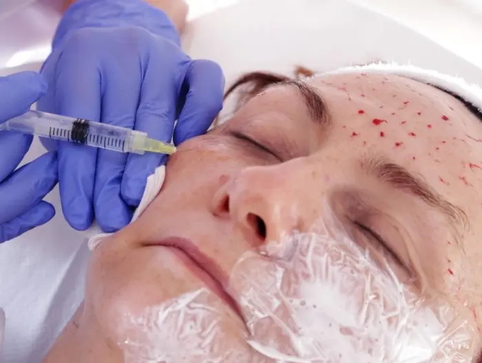 Does Vampire Facial Help with Sun-Damaged Skin Repair?