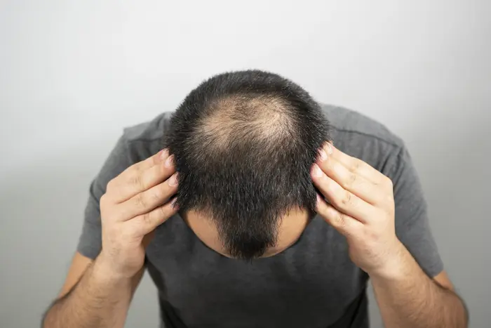 Does Crown Hair Transplant Work for Thinning Hair Only?