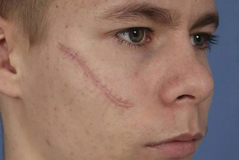 How Effective Is Scar Removal For Improving Skin Texture?
