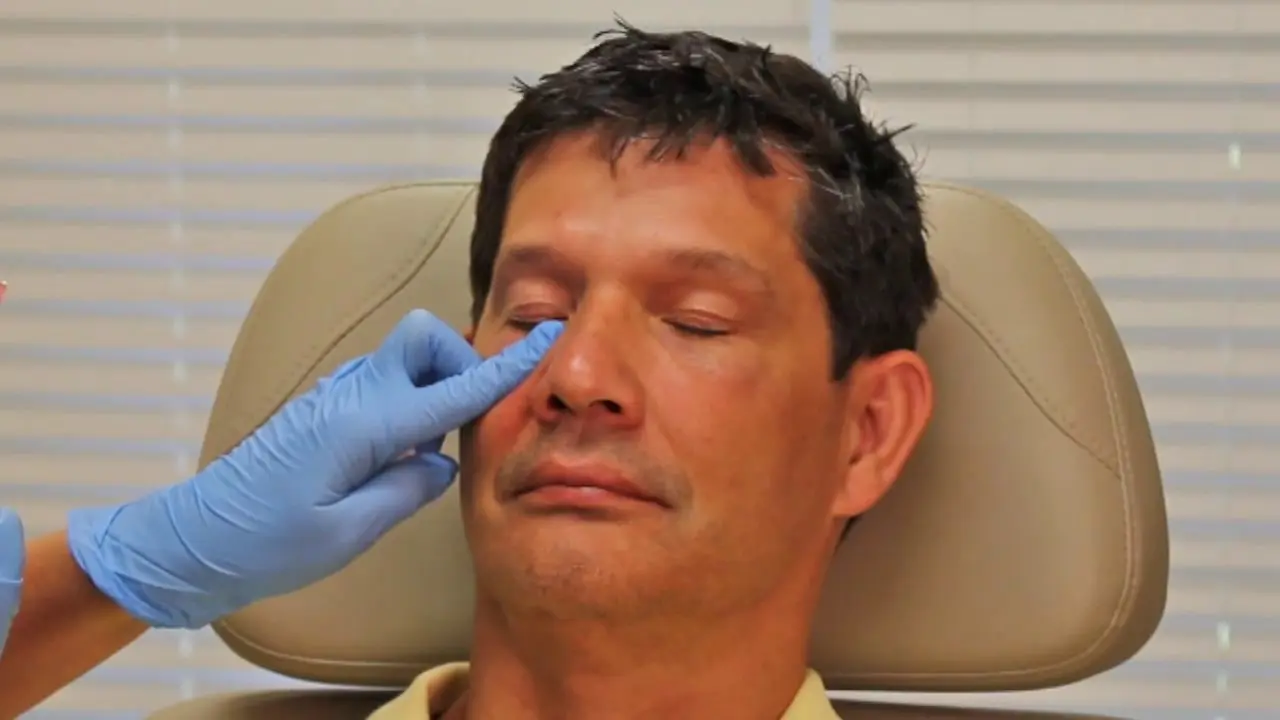 How Does Under-Eye Filler Treatment Reduce Dark Hollow Eyes?