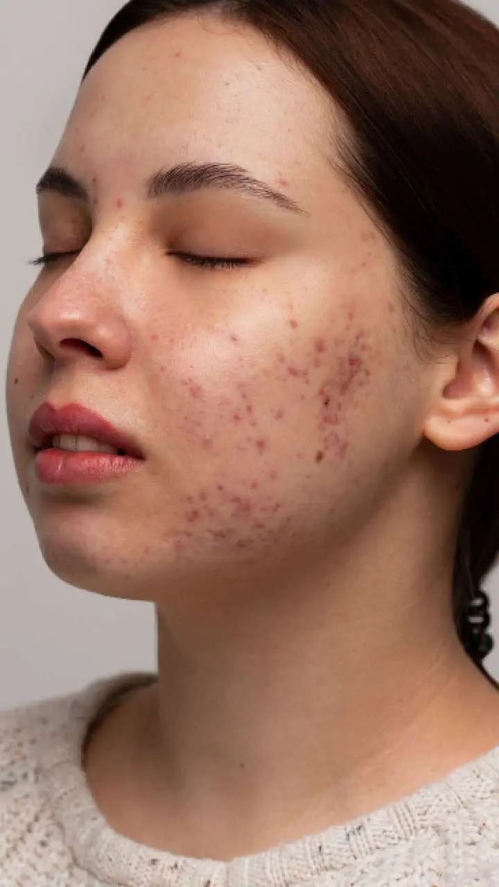 How Does Pimples Treatment Improve Acne-Prone Skin Health?