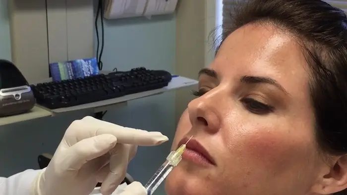 How Does a Lip Lift Enhance Upper Lip Appearance Naturally?
