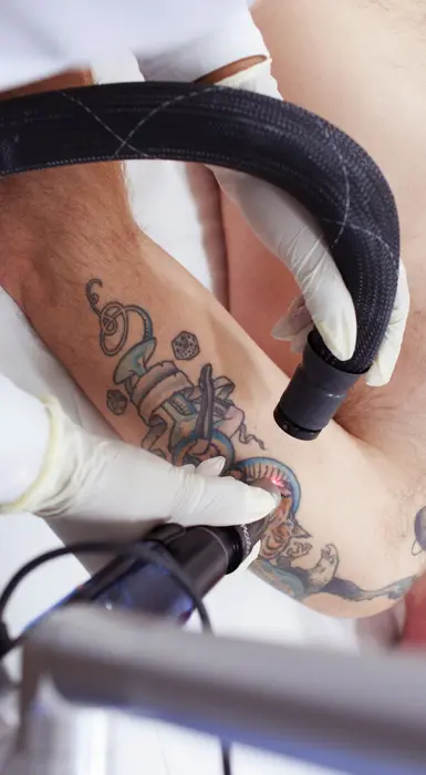 How Does Pico Laser Feel During the Treatment Session?