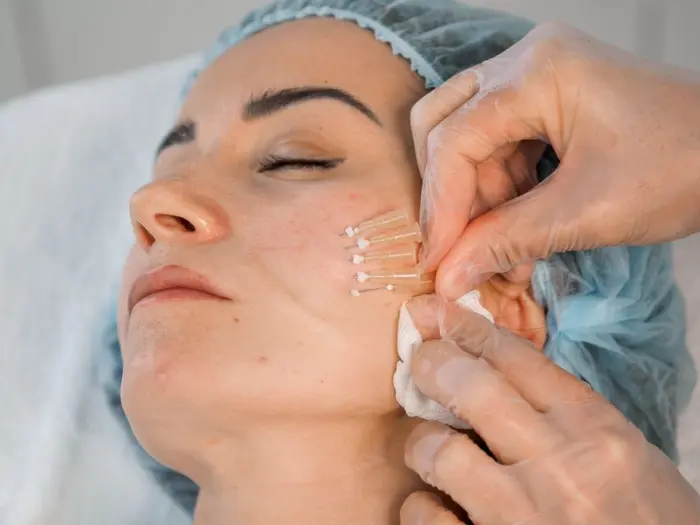 Are PDO Mono Threads Good for Mild Skin Sagging?