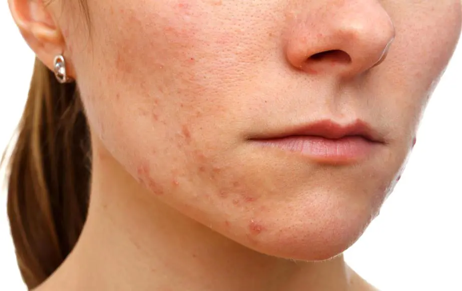 How Does Pimples Treatment Restore Skin’s Natural Clarity Balance?