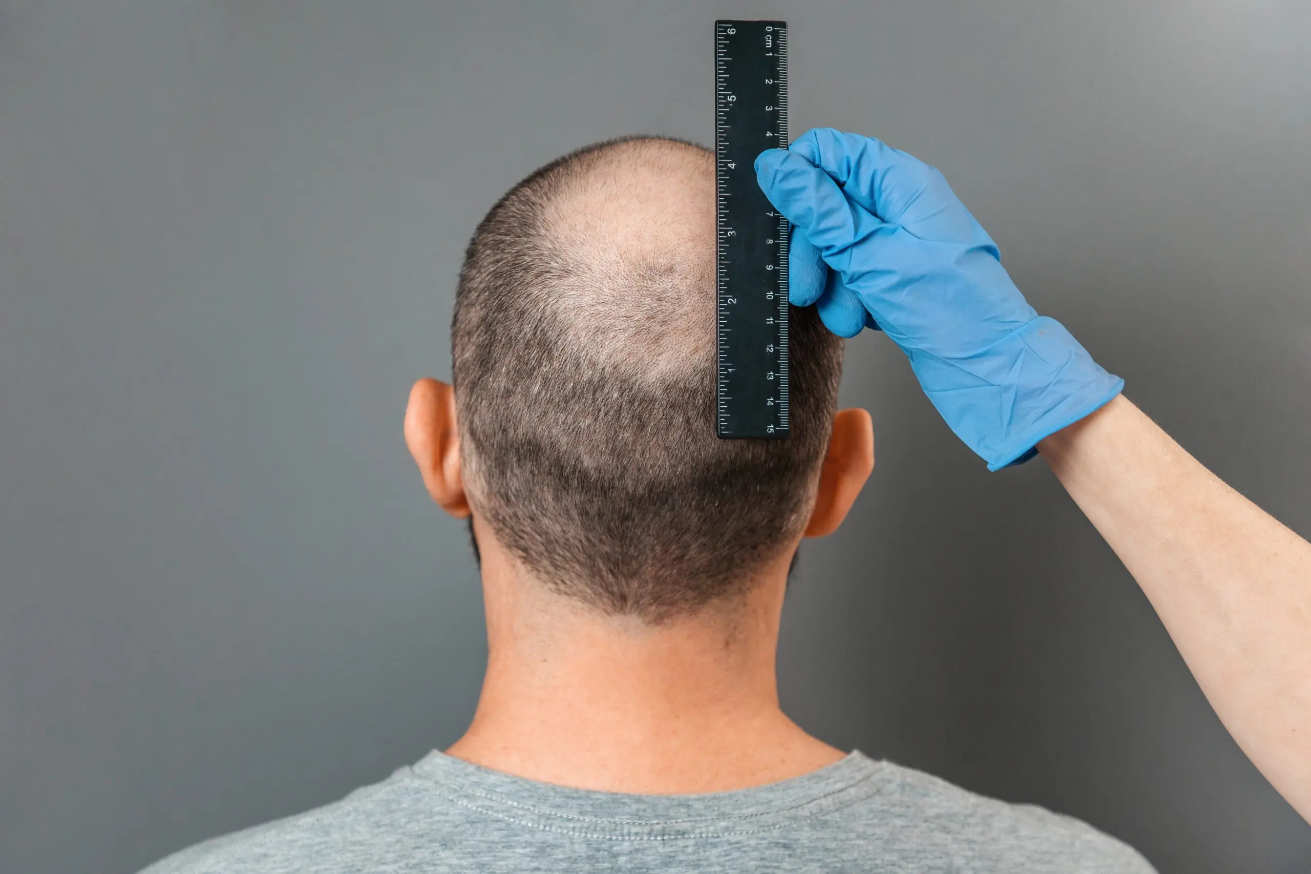 Can Crown Hair Transplant Restore Realistic Hair Growth Look?