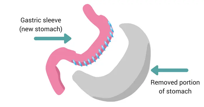 How Does Gastric Plication Help With Weight Loss?