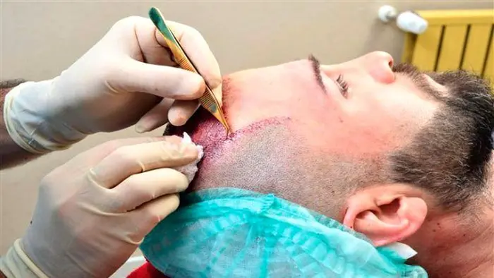 Who Should Consider FUSS Hair Transplant for Baldness?