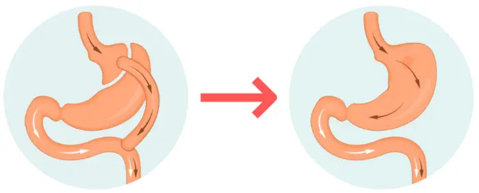 What Is Gastric Bypass Surgery and How Does It Work?