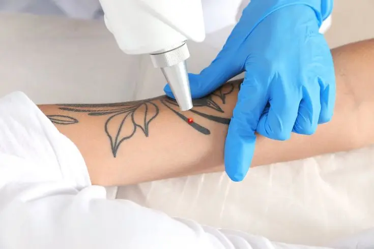 How Does Laser Tattoo Removal Deliver Long-Term Results?