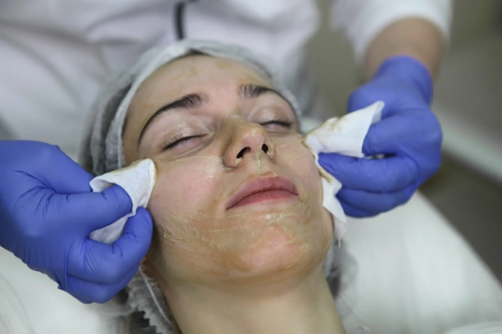 How Does Cosmelan Peel Reduce Pigmentation and Dark Spots?