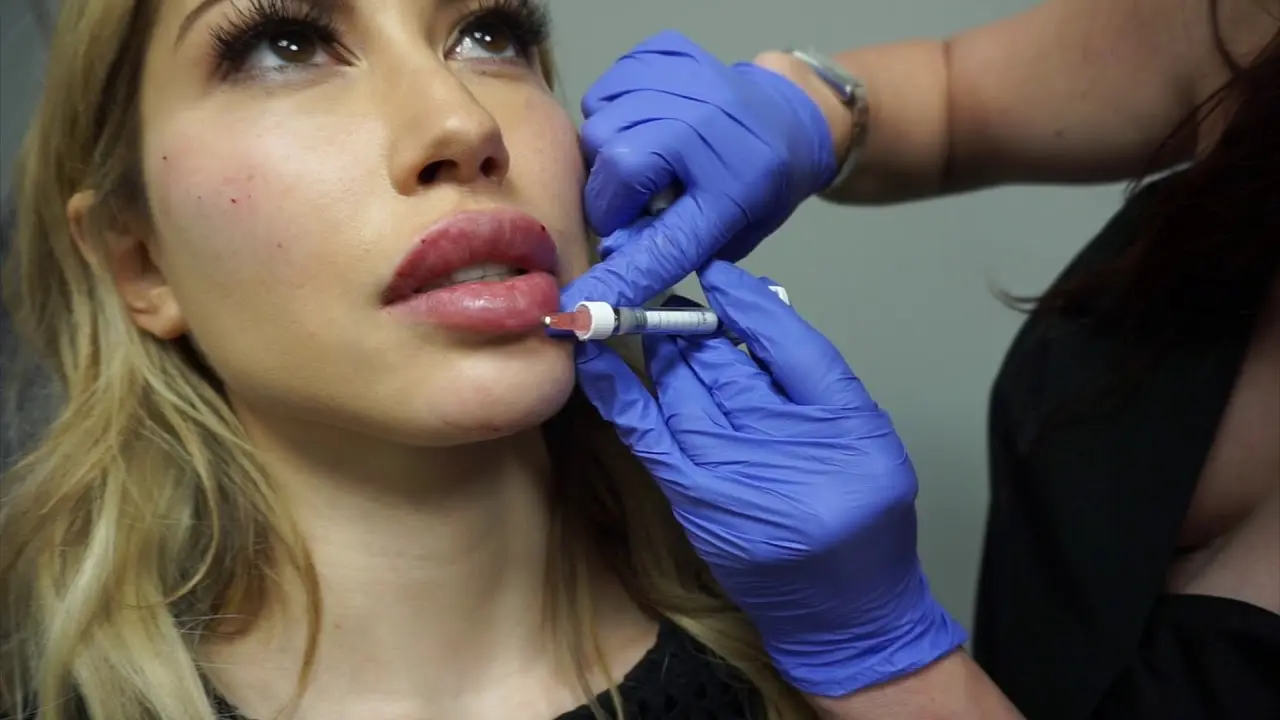 How Does Best Lip Fillers Injection Define Lip Contours?